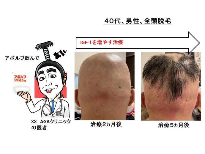 円形脱毛症　病院